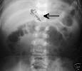 ALIEN IMPLANT REMOVED FROM A MANS SPINE!    AMAZING!!!