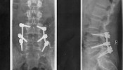 Verkaufe Implantate von meiner Wirbelsulen Op/Versteifung Spondylodese Fixateur